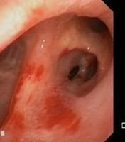 Tracheobronchial mucosa and bronchial wall