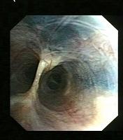 Anthracosis