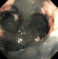 Inhalation injury and soot deposition