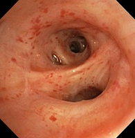 Petechial mucosa