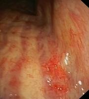 Hypervascularized mucosa