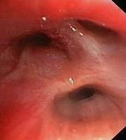 Congestive mucosa (oedematous, erythematous)