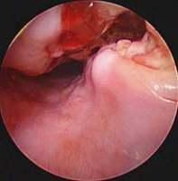 Oesophageal visualisation of the fistula 2