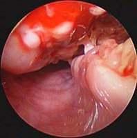 Oesophageal visualisation of the fistula