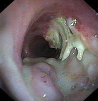 Tracheo-eosophageal fistula with erosion of the tracheal rings