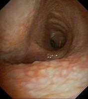 Granular mucosa