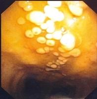 Mucosal circumscribed lesions