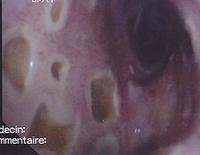 Mucosal ulcers