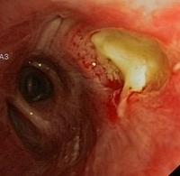 Ulcer of the truncus intermedius