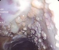 Mucosa covered with a white membrane and multiple vesicles