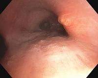 Nodular lesion of the mucosa