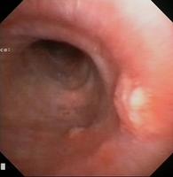 Nodular irregularity of the mucosa