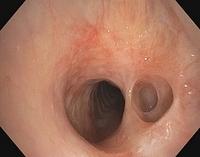 Tracheal and bronchial diverticula