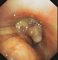 Exophytic lesion with irregular polylobulated surface