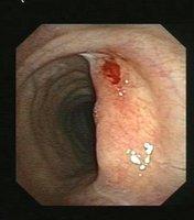 Structural stenosis or obstruction