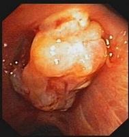Exophytic lesion occluding the right upper lobe bronchus