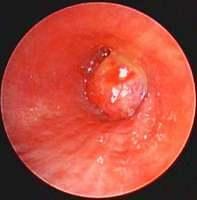 Exophytic lesion occluding the truncus intermedius