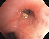 Stenosis associated with tuberculosis (RUL)