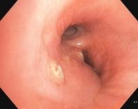 Stenosis associated with tuberculosis (RLL)