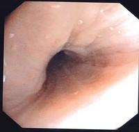 Stenosis due to mucosal oedema