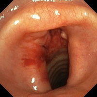 Tracheal (pseudo-glottic) stenosis after tracheostomy