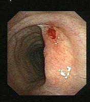 Tracheal stenosis post tracheostomy