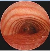 Dilatation of the tracheal lumen (tracheomegaly, trachiectasis)