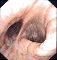 Mucosal fold