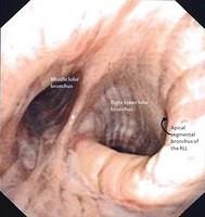 Mucosal fold with annotations