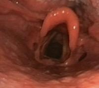 Erythematous epiglottis