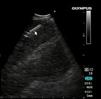 Linear/convex endobronchial ultrasound (EBUS-TBNA)