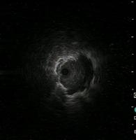 Radial ultrasound: miniprobe adjacent to the nodular lesion
