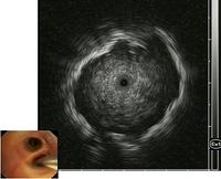 Radial ultrasound: tumour visualisation