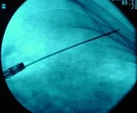 BTB: the biopsy forceps is advanced to the periphery of the lung until resistance is encountered