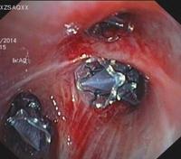 Bronchoscopic lung volume reduction