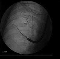 Lung volume reduction with coils: the guidewire is advanced to the targeted area
