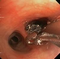 Removal of endobronchial valves