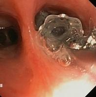 Endobronchial valve removal