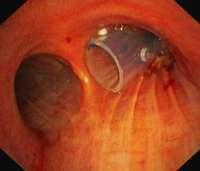 OKI stent placed in the right mainstem bronchus