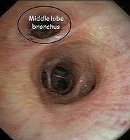 Middle lobe: bronchoscope in the truncus intermedius - annotations