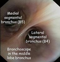 Middle lobe bronchus - annotations