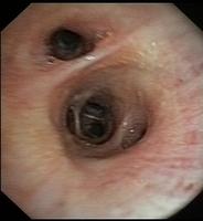 Middle lobe: bronchoscope in the truncus intermedius