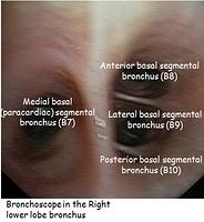 Right basal segmental bronchi