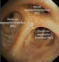 Right upper lobe bronchus - annotations