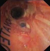 Anastomotic dehiscence visualised through an OKI stent