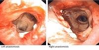 Anastomoses: day 0 of transplantation