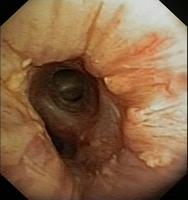 Left anastomosis (unilateral transplantation): 6 months after transplantation