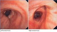 Normal anastomoses: 6 years after lung transplantation