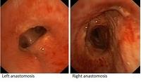 Anastomoses: 11 years after transplantation