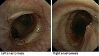 Anastomoses: 3 months after transplantation